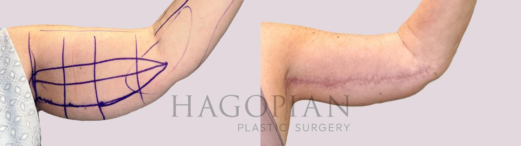 Before & After Lipedema Surgery Case 166 Left Side View in Atlanta, GA