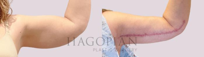 Before & After Arm Lift Case 169 Left Side View in Atlanta, GA