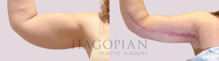 Before & After Arm Lift Case 169 Right Side View in Atlanta, GA