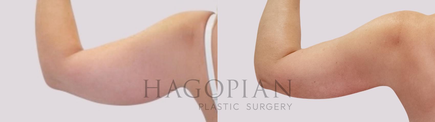 Before & After Arm Lift Case 171 Back Left View in Atlanta, GA