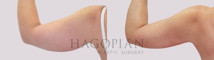 Before & After Arm Lift Case 171 Back Left View in Atlanta, GA