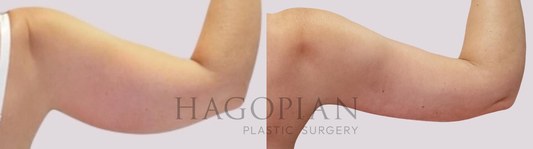 Before & After Arm Lift Case 171 Back Right View in Atlanta, GA