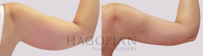 Before & After Arm Lift Case 171 Back Right View in Atlanta, GA