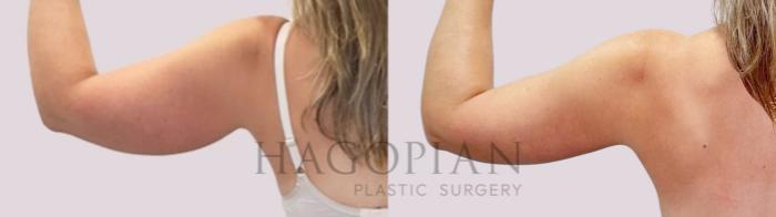 Before & After Arm Lift Case 171 Back View in Atlanta, GA