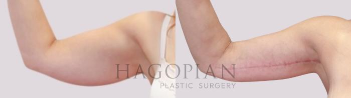 Before & After Arm Lift Case 171 Front Left View in Atlanta, GA