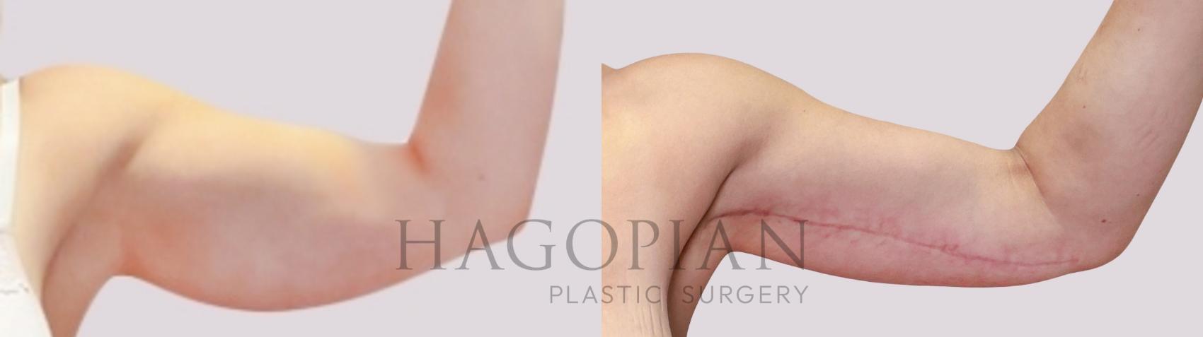 Before & After Arm Lift Case 171 Front Right View in Atlanta, GA