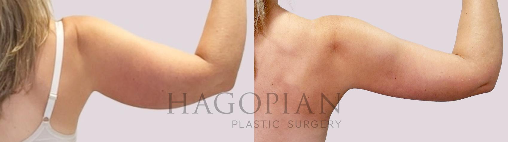 Before & After Arm Lift Case 171 Right Side View in Atlanta, GA