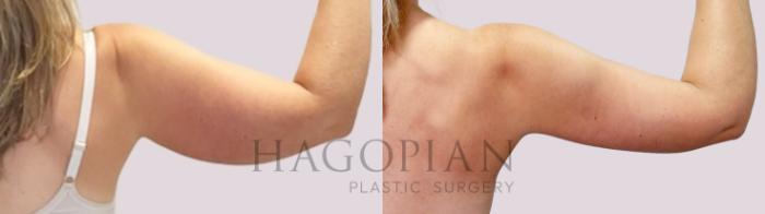 Before & After Arm Lift Case 171 Right Side View in Atlanta, GA