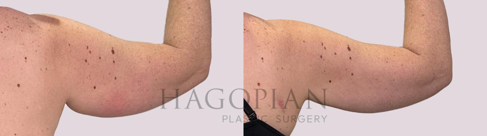 Before & After Liposuction Case 178 Back View in Atlanta, GA