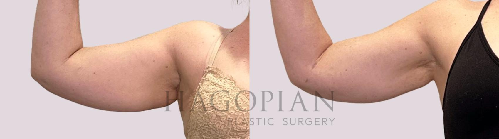 Before & After Liposuction Case 178 Front View in Atlanta, GA