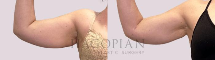 Before & After Arm Lift Case 178 Front View in Atlanta, GA