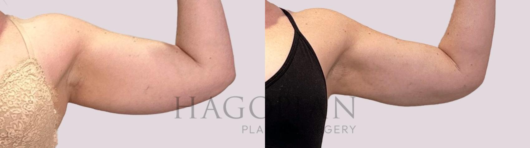 Before & After Liposuction Case 178 Right Side View in Atlanta, GA