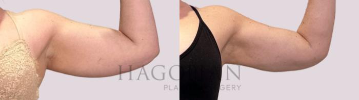 Before & After Arm Lift Case 178 Right Side View in Atlanta, GA