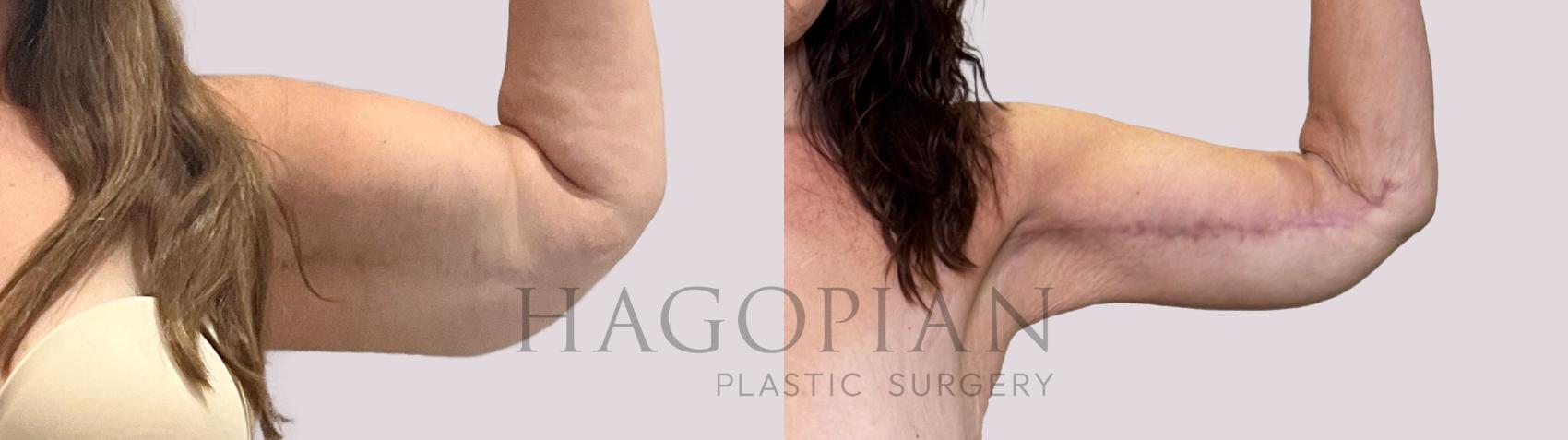 Before & After Arm Lift Case 187 Front View in Atlanta, GA