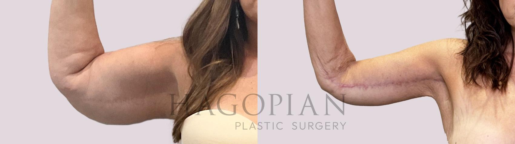 Before & After Arm Lift Case 187 Right Side View in Atlanta, GA