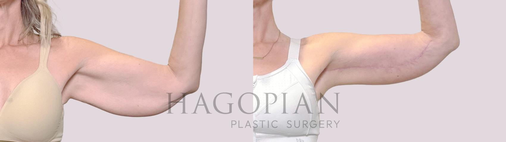 Before & After Arm Lift Case 188 Front View in Atlanta, GA