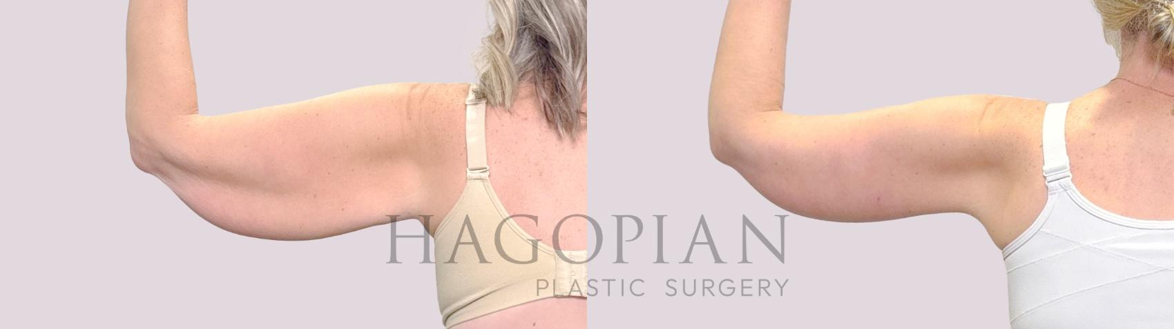 Before & After Arm Lift Case 188 Left Side View in Atlanta, GA