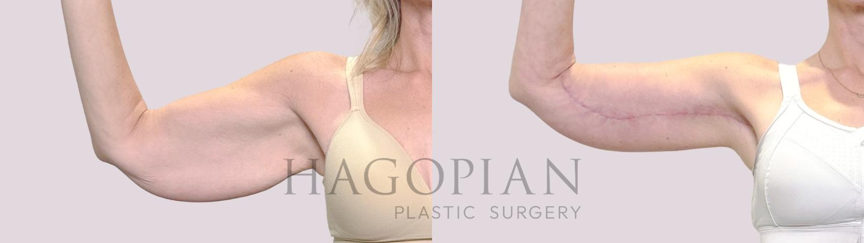 Before & After Arm Lift Case 188 Right Side View in Atlanta, GA