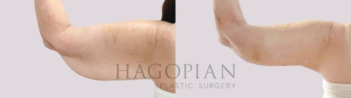 Before & After Arm Lift Case 190 Back Left View in Atlanta, GA