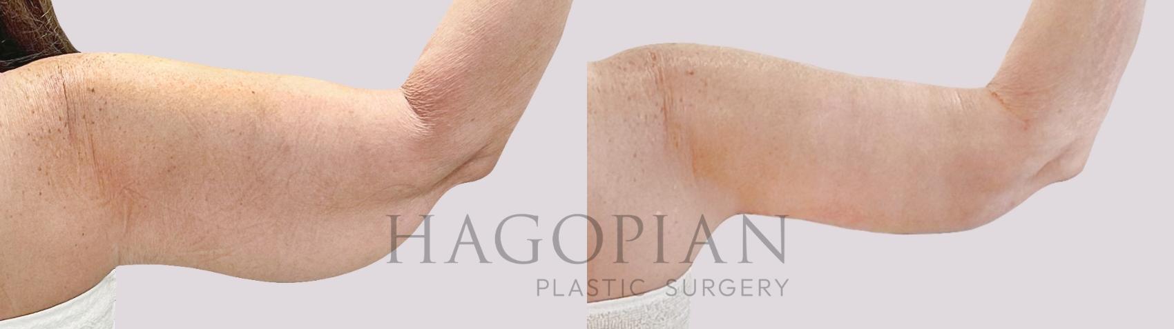 Before & After Arm Lift Case 190 Back Right View in Atlanta, GA