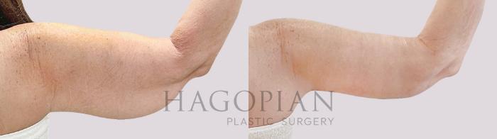 Before & After Arm Lift Case 190 Back Right View in Atlanta, GA