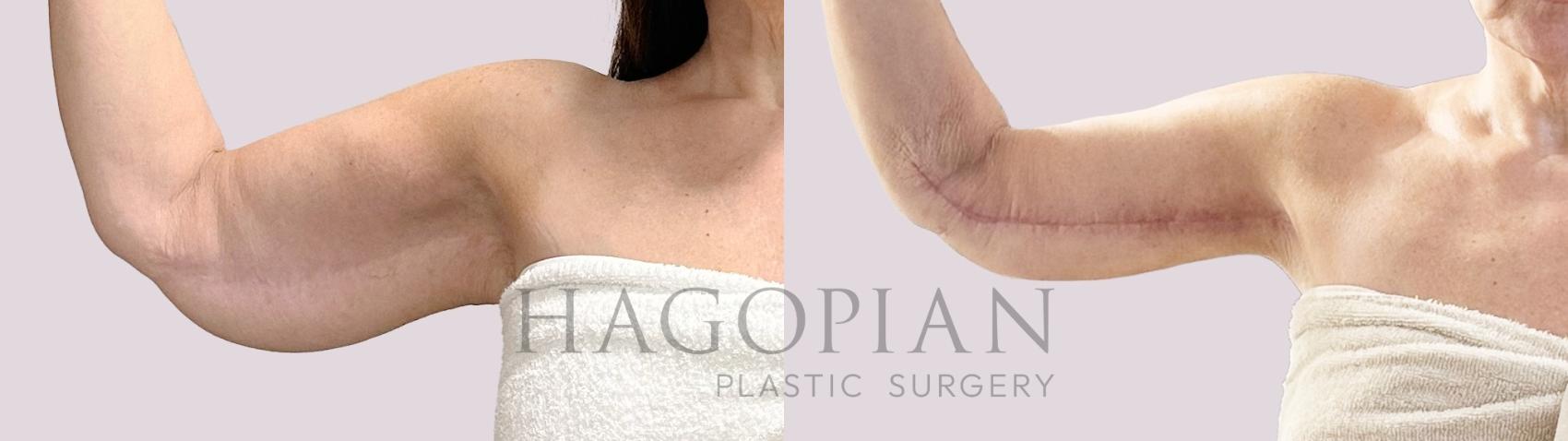 Before & After Arm Lift Case 190 Front View in Atlanta, GA
