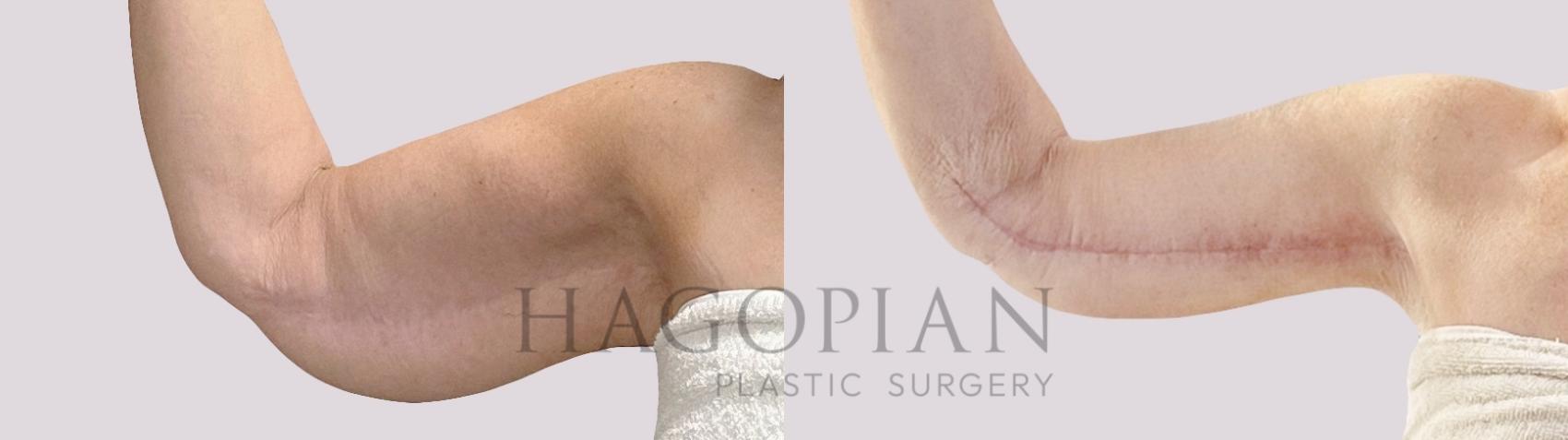 Before & After Arm Lift Case 190 Front Left View in Atlanta, GA