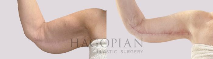 Before & After Arm Lift Case 190 Front Left View in Atlanta, GA