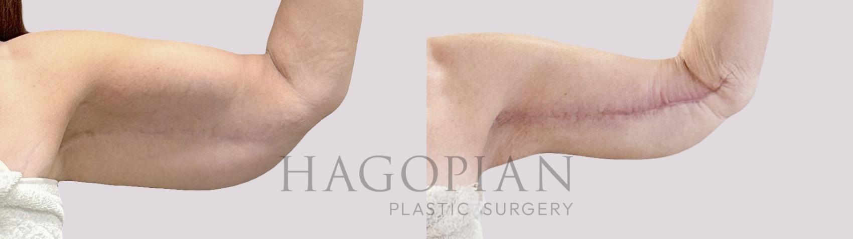 Before & After Arm Lift Case 190 Front Right View in Atlanta, GA