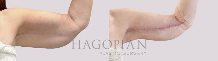 Before & After Arm Lift Case 190 Front Right View in Atlanta, GA