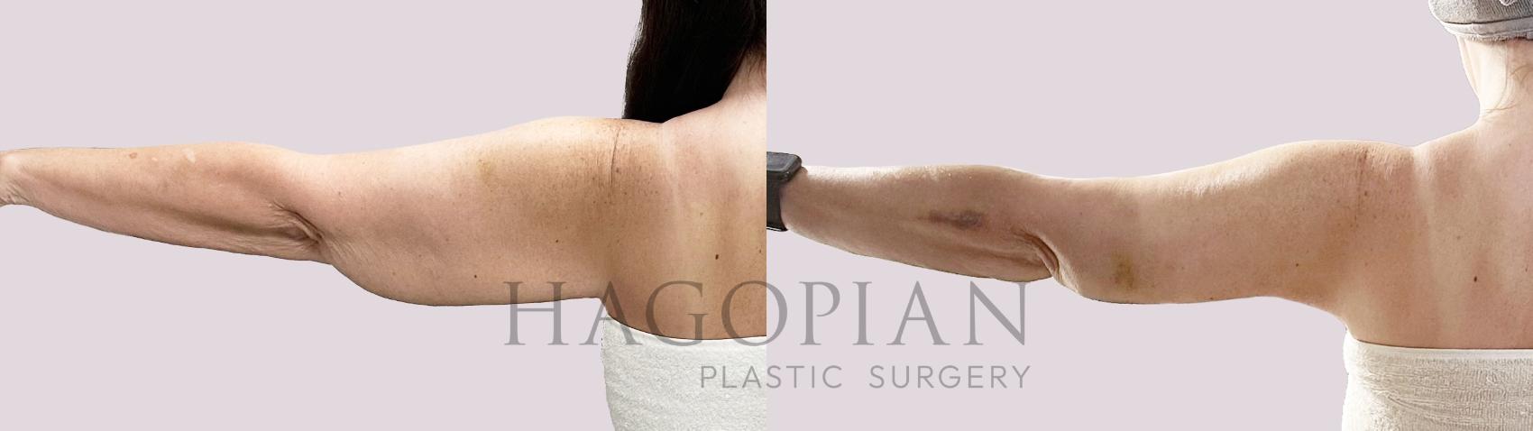 Before & After Lipedema Surgery Case 190 Left Oblique View in Atlanta, GA