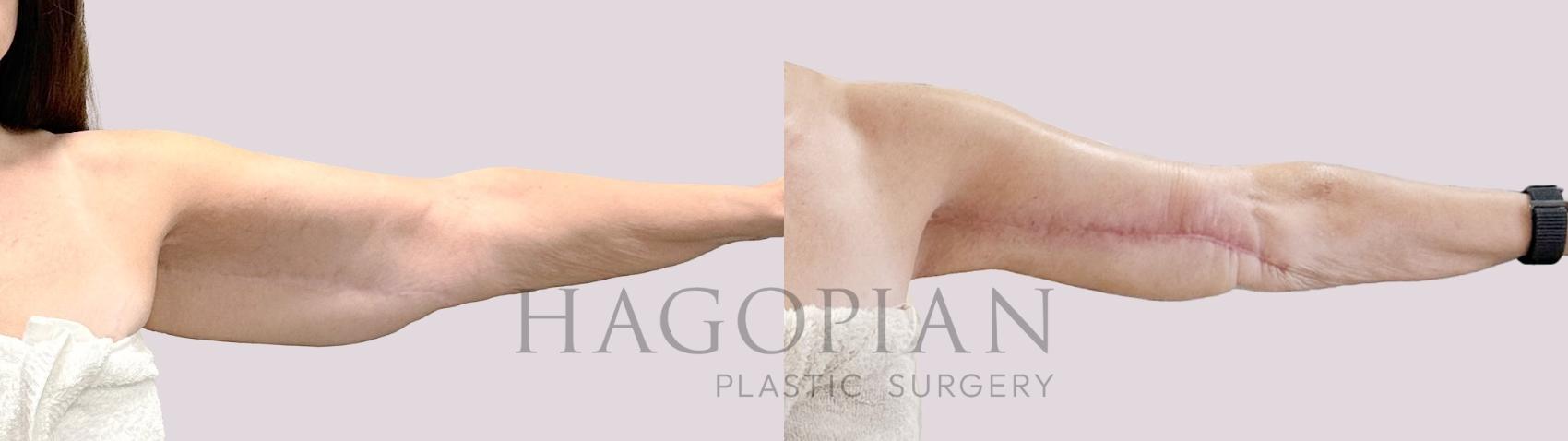 Before & After Lipedema Surgery Case 190 Left Side View in Atlanta, GA