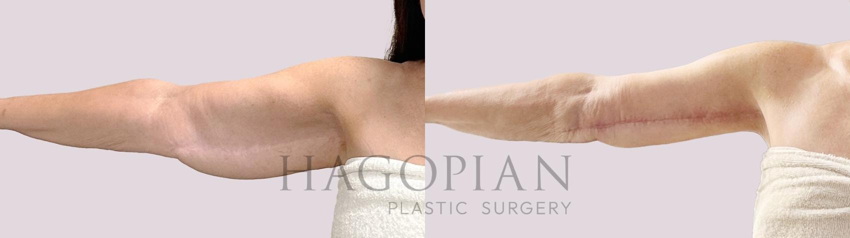 Before & After Lipedema Surgery Case 190 Right Side View in Atlanta, GA