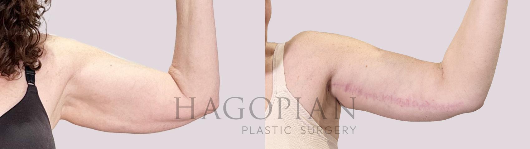 Before & After Arm Lift Case 193 Left Side View in Atlanta, GA
