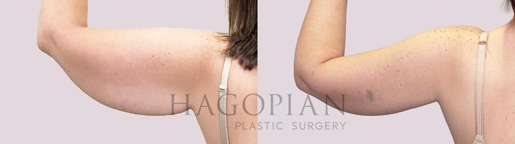 Before & After Arm Lift Case 197 Back View in Atlanta, GA