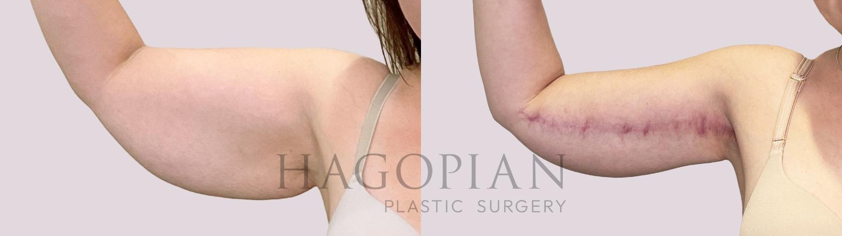 Before & After Arm Lift Case 197 Front View in Atlanta, GA
