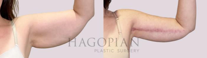 Before & After Arm Lift Case 197 Left Side View in Atlanta, GA