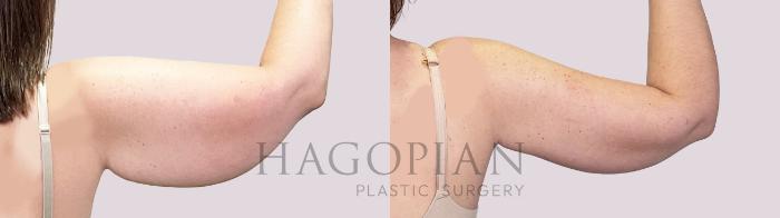 Before & After Arm Lift Case 197 Right Side View in Atlanta, GA
