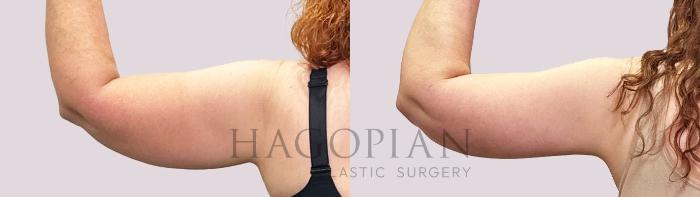 Before & After Arm Lift Case 199 Back View in Atlanta, GA