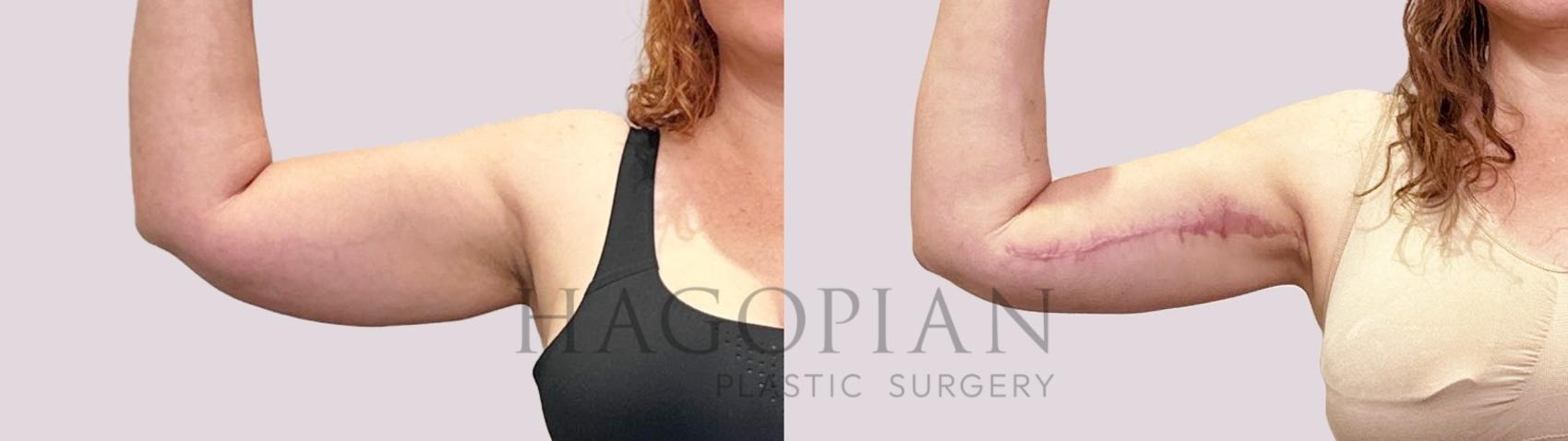 Before & After Arm Lift Case 199 Front View in Atlanta, GA