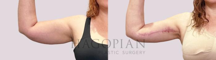 Before & After Arm Lift Case 199 Front View in Atlanta, GA