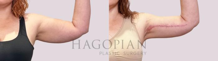 Before & After Arm Lift Case 199 Left Side View in Atlanta, GA