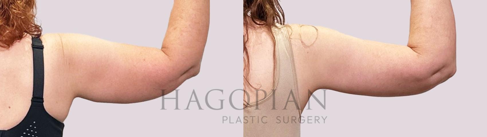 Before & After Arm Lift Case 199 Right Side View in Atlanta, GA
