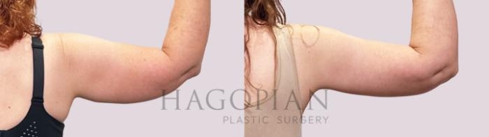 Before & After Arm Lift Case 199 Right Side View in Atlanta, GA