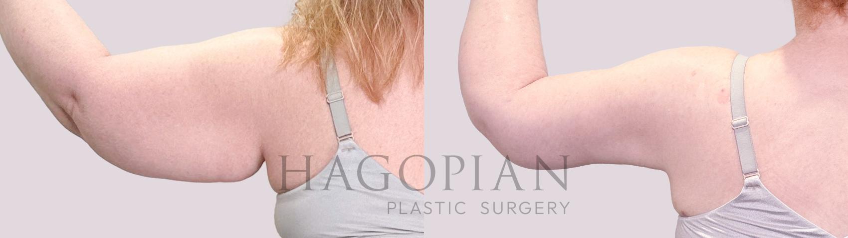 Before & After Arm Lift Case 203 Back View in Atlanta, GA