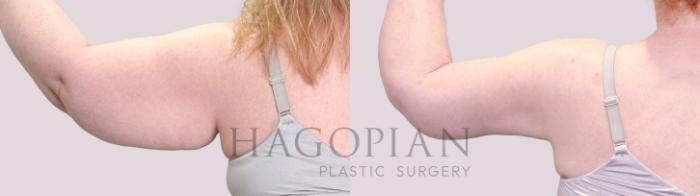 Before & After Arm Lift Case 203 Back View in Atlanta, GA