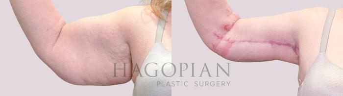 Before & After Arm Lift Case 203 Front View in Atlanta, GA
