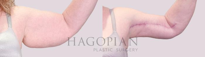 Before & After Arm Lift Case 203 Left Side View in Atlanta, GA
