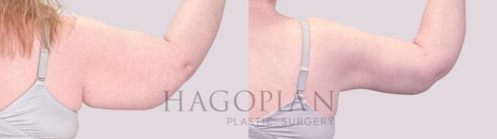 Before & After Arm Lift Case 203 Right Side View in Atlanta, GA