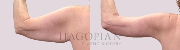 Before & After Arm Lift Case 208 Left Oblique View in Atlanta, GA